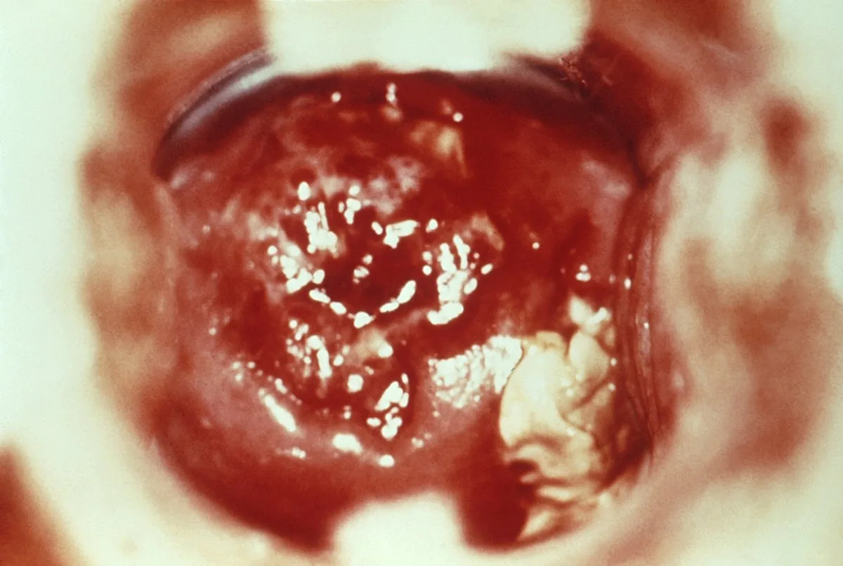 Cervicitis – Colposcopy: Ulcerating cervicitis