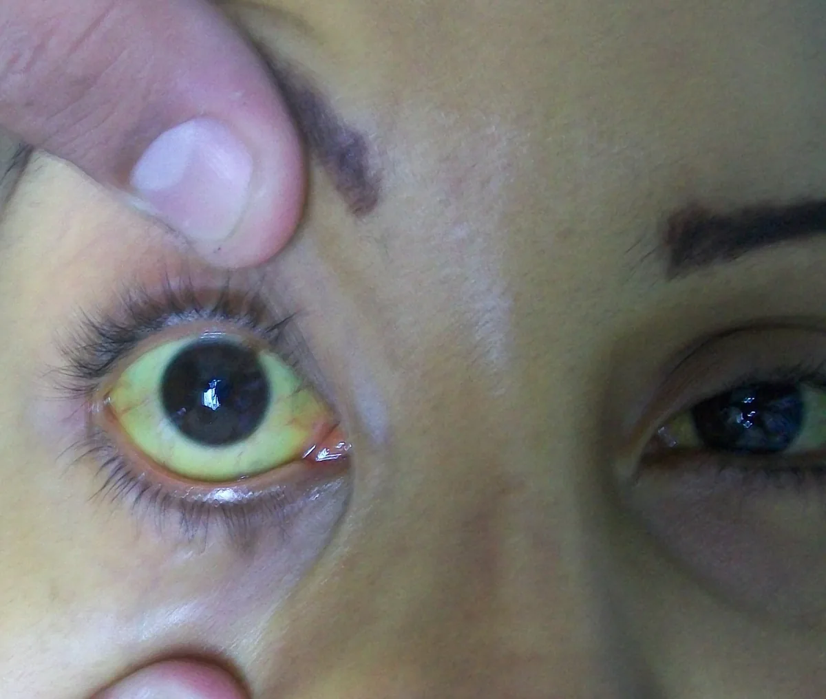 Choledocholithiasis and acute cholangitis – clinical photo: Scleral icterus