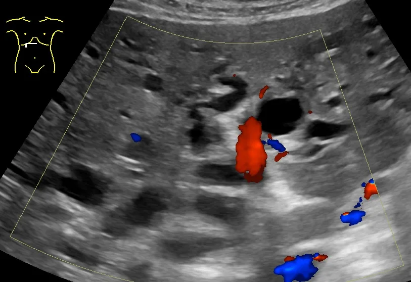 Choledocholithiasis and acute cholangitis – Ultrasound: dilated bile ducts in cholestasis
