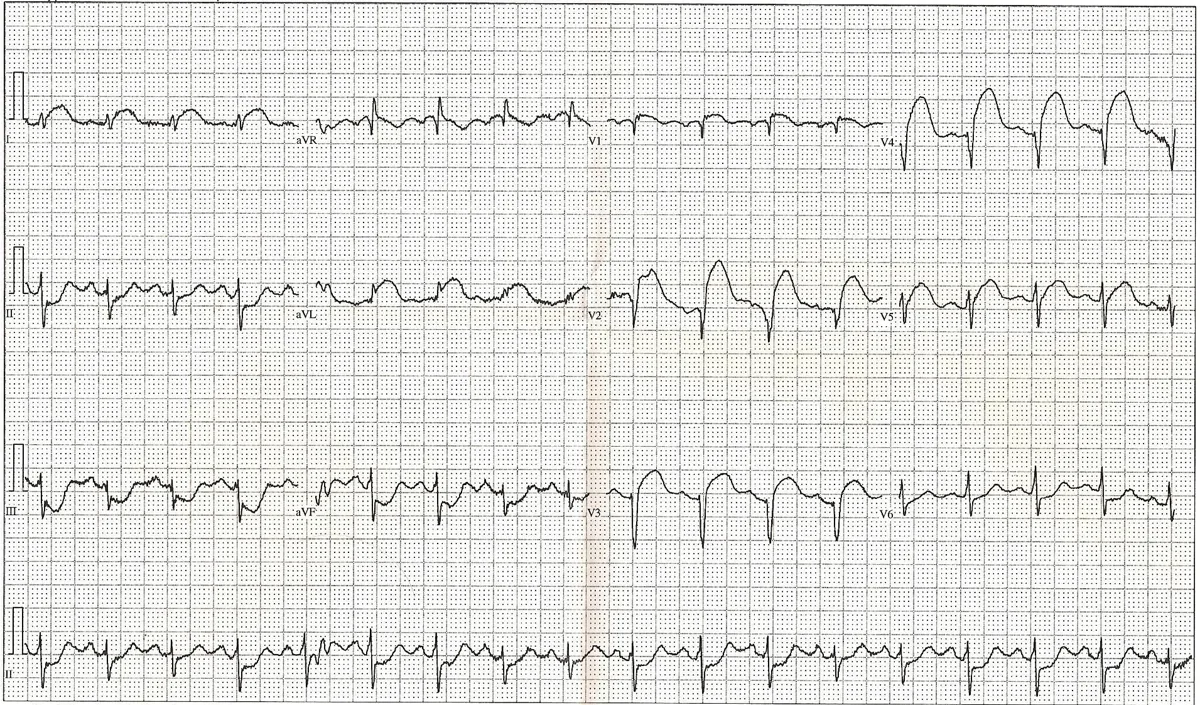 Akutes Koronarsyndrom (Herzinfarkt, STEMI/NSTEMI) – EKG: 12-Kanal-EKG mit ST-Streckenhebungen