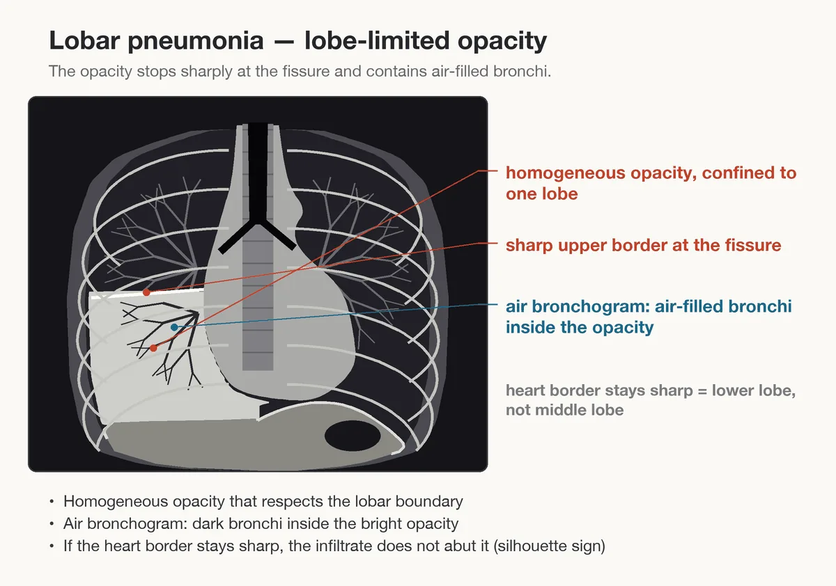 Community-acquired pneumonia – diagram: Diagram: radiological signs of lobar pneumonia