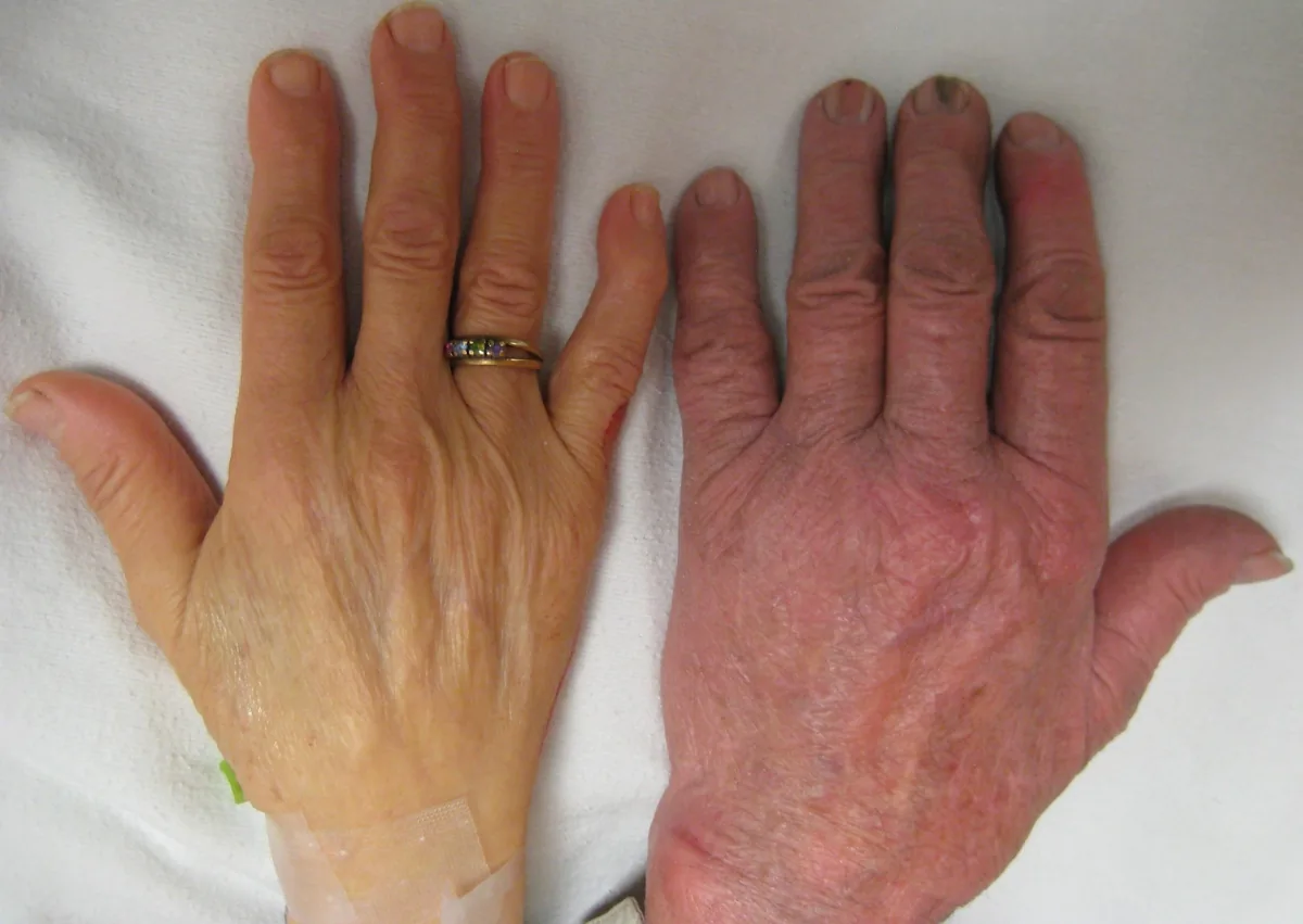 Anämie (Einteilung und Abklärung, Blutarmut) – klinisches Foto: Blässe: links blasse Hand bei schwerer Anämie, rechts zum Vergleich normal durchblutete Hand