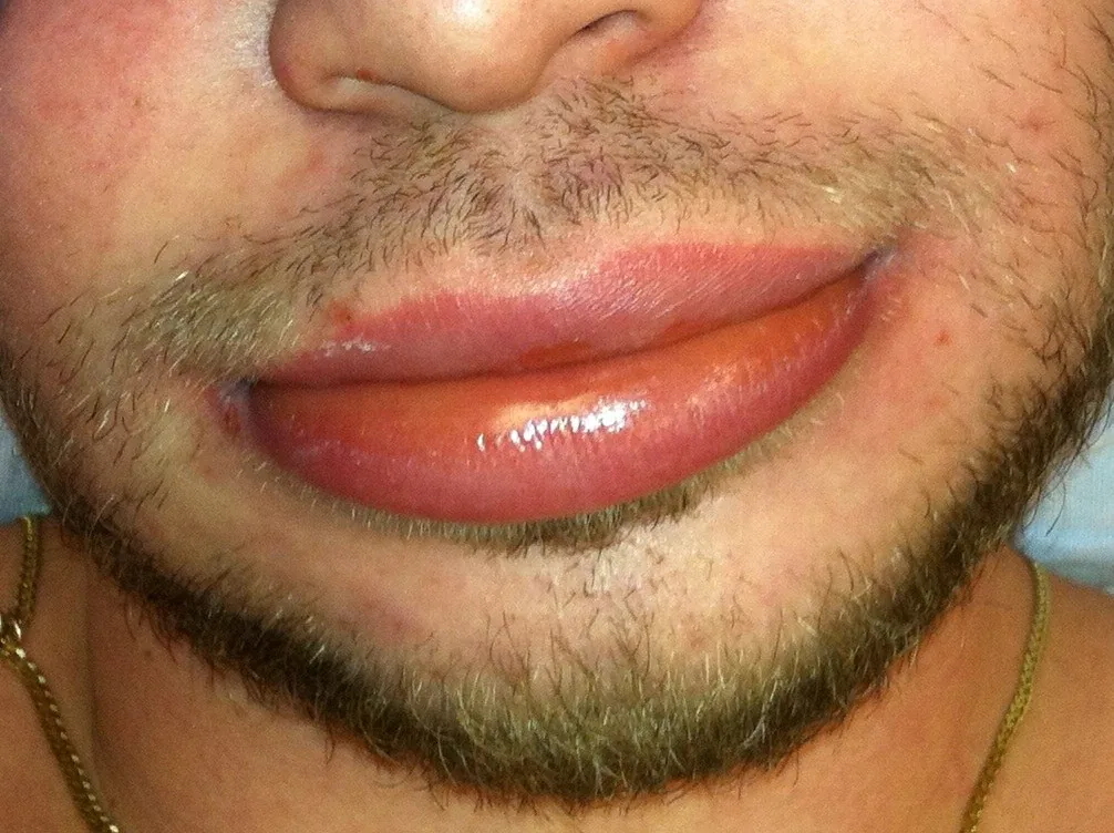 Angiedema (bradykinin- and histamine-mediated) – clinical photo: Angiedema of the lip