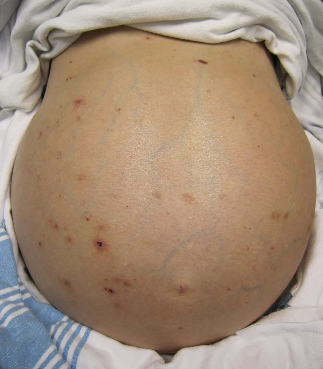 Ascites – clinical photo: Distended abdomen with marked ascites