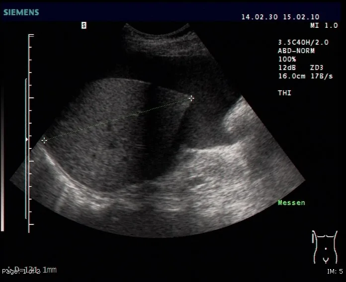 Ascites – Ultrasound: free fluid