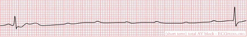 Atrioventricular block – ECG: Third-degree AV block: P waves and QRS complexes dissociated
