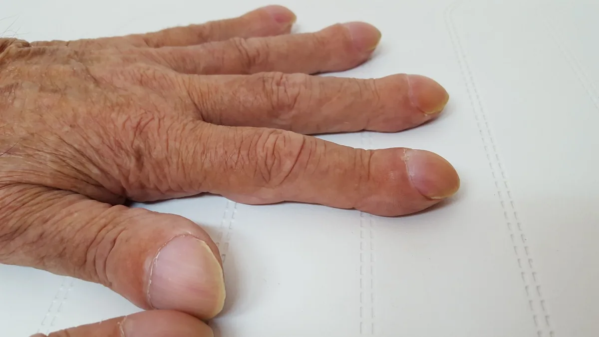 Bronchiectasis – clinical photo: Digital clubbing