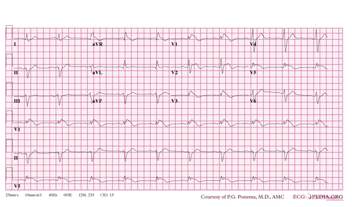 Brugada syndrome – ECG: Type 1 Brugada pattern: coved ST elevation in V1/V2