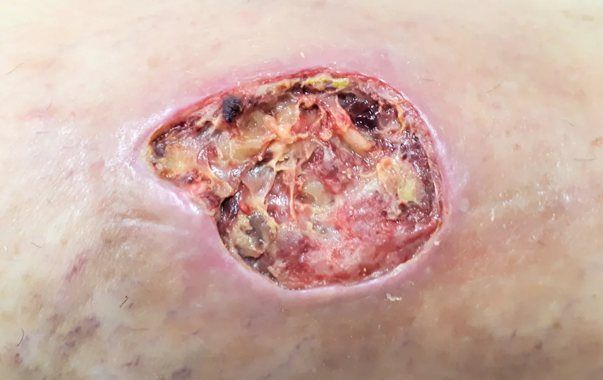 Chronic venous insufficiency – clinical photo: Venous leg ulcer