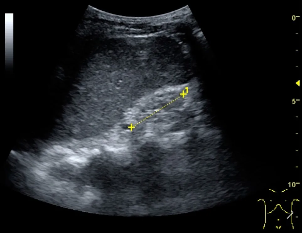 Chronic kidney disease – Ultrasound: small kidney with thinned parenchyma