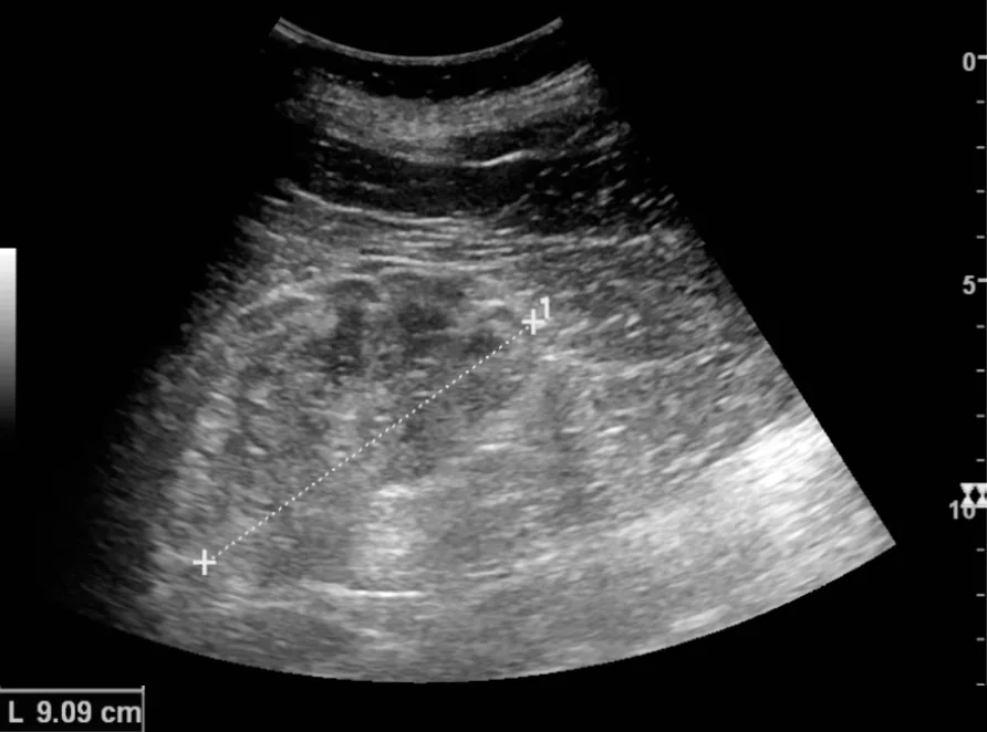 Chronic kidney disease – Ultrasound in chronic kidney disease