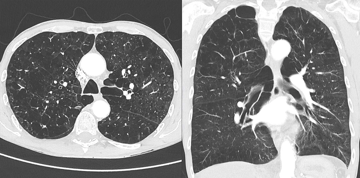 Alpha-1 antitrypsin deficiency – CT (axial and coronal): panlobular emphysema with diffuse loss of lung parenchyma and attenuated vessels – the typical emphysema pattern in AAT deficiency