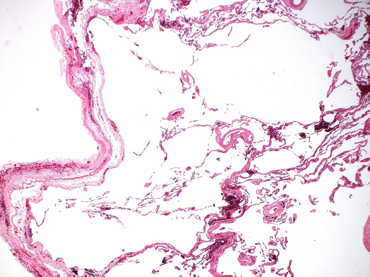 Alpha-1 antitrypsin deficiency – Histology (H&E) in alpha-1 antitrypsin deficiency: panlobular emphysema with uniform destruction of alveolar walls throughout the lobule
