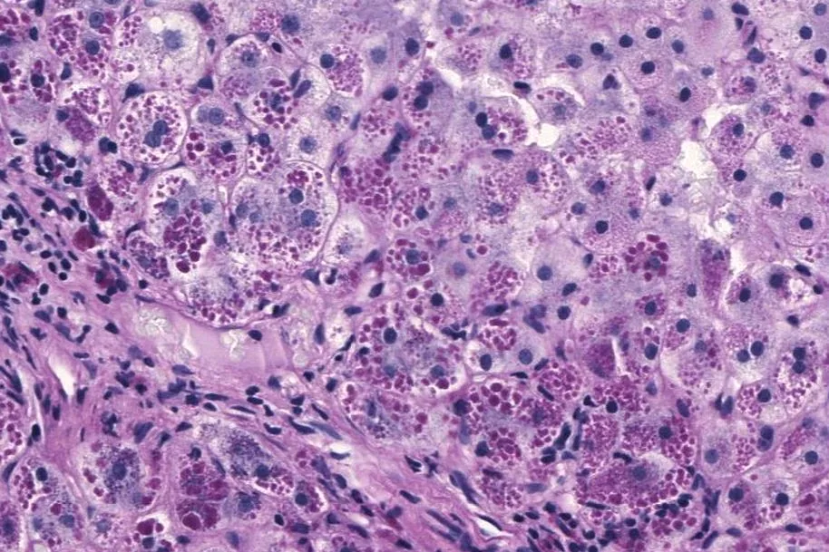 Alpha-1 antitrypsin deficiency – histology: Liver biopsy (PAS-diastase stain) in alpha-1 antitrypsin deficiency: diastase-resistant pink globules in hepatocytes