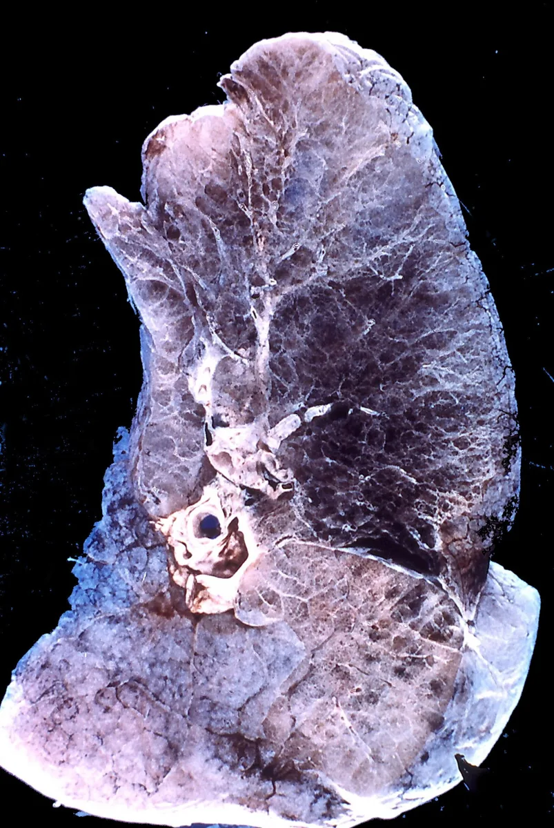 Alpha-1 antitrypsin deficiency – Gross specimen (lung slice): panlobular emphysema with diffuse, uniform rarefaction of lung tissue