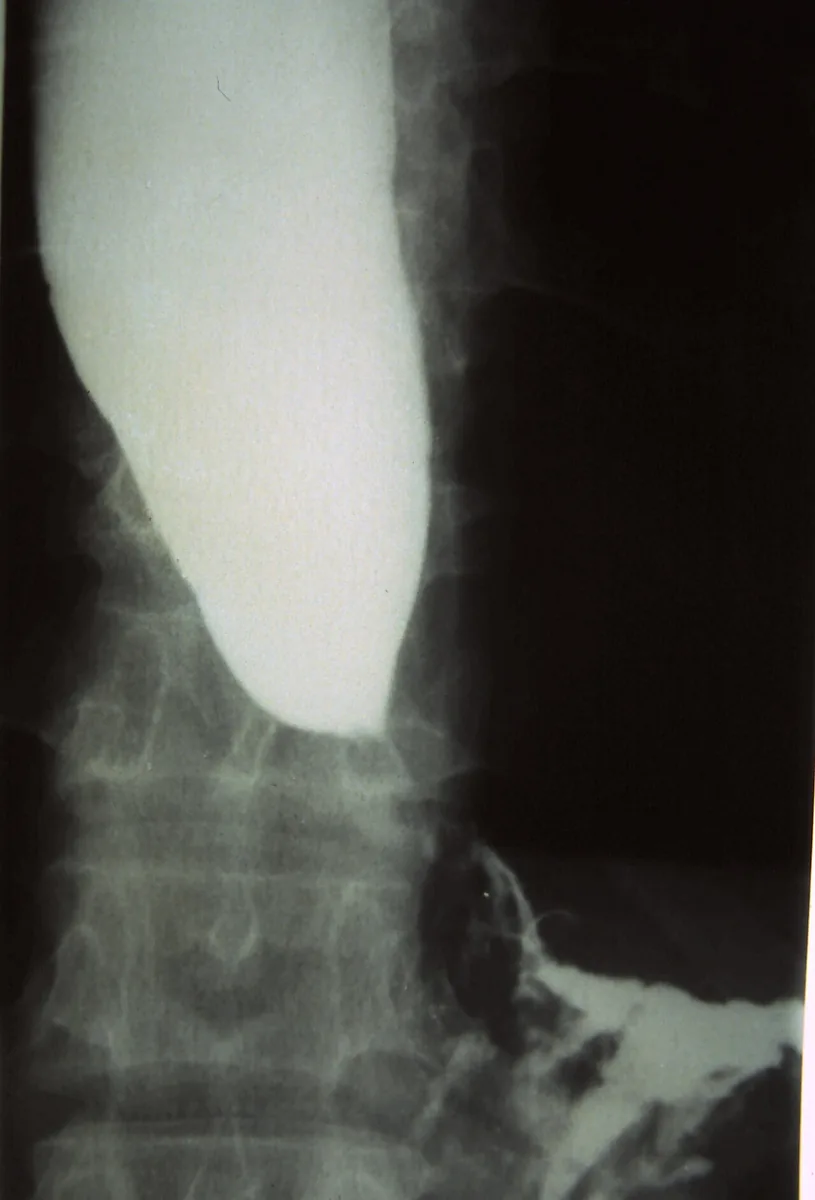 Achalasia – X-ray: Barium swallow: dilated esophagus with a retained column of contrast and smooth, beak-like narrowing at the gastro-esophageal junction ('bird's beak')
