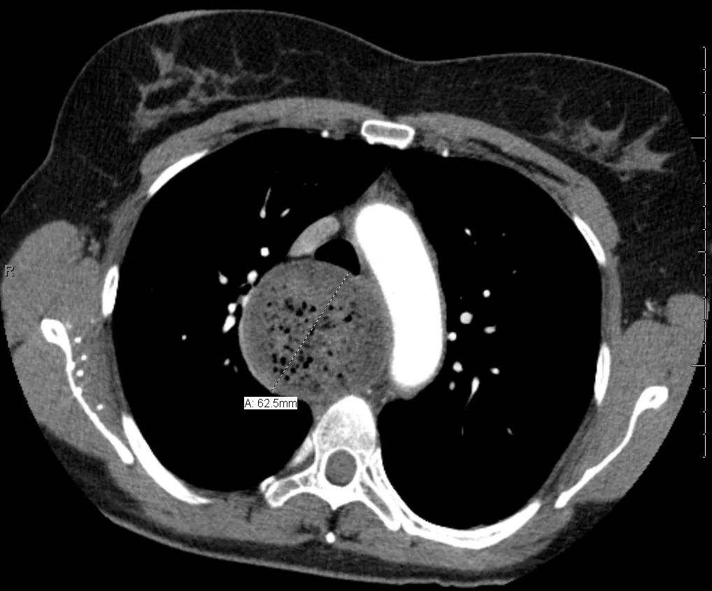 Achalasia – Axial chest CT: markedly dilated esophagus filled with retained food and air (measured about 6 cm)