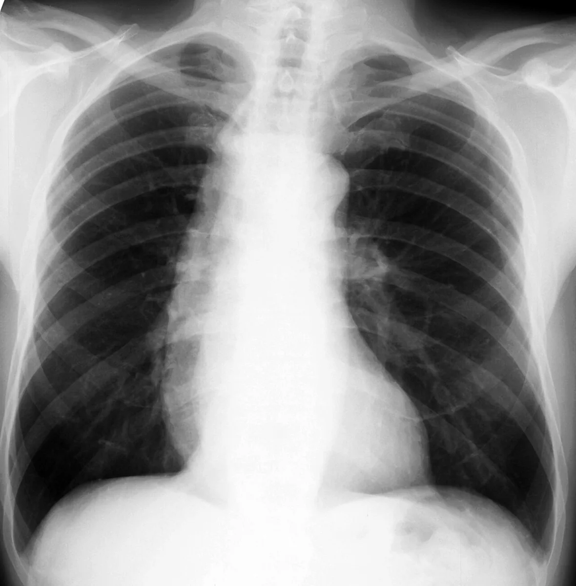 Achalasia – Chest X-ray: widened mediastinum on the right caused by the markedly dilated esophagus