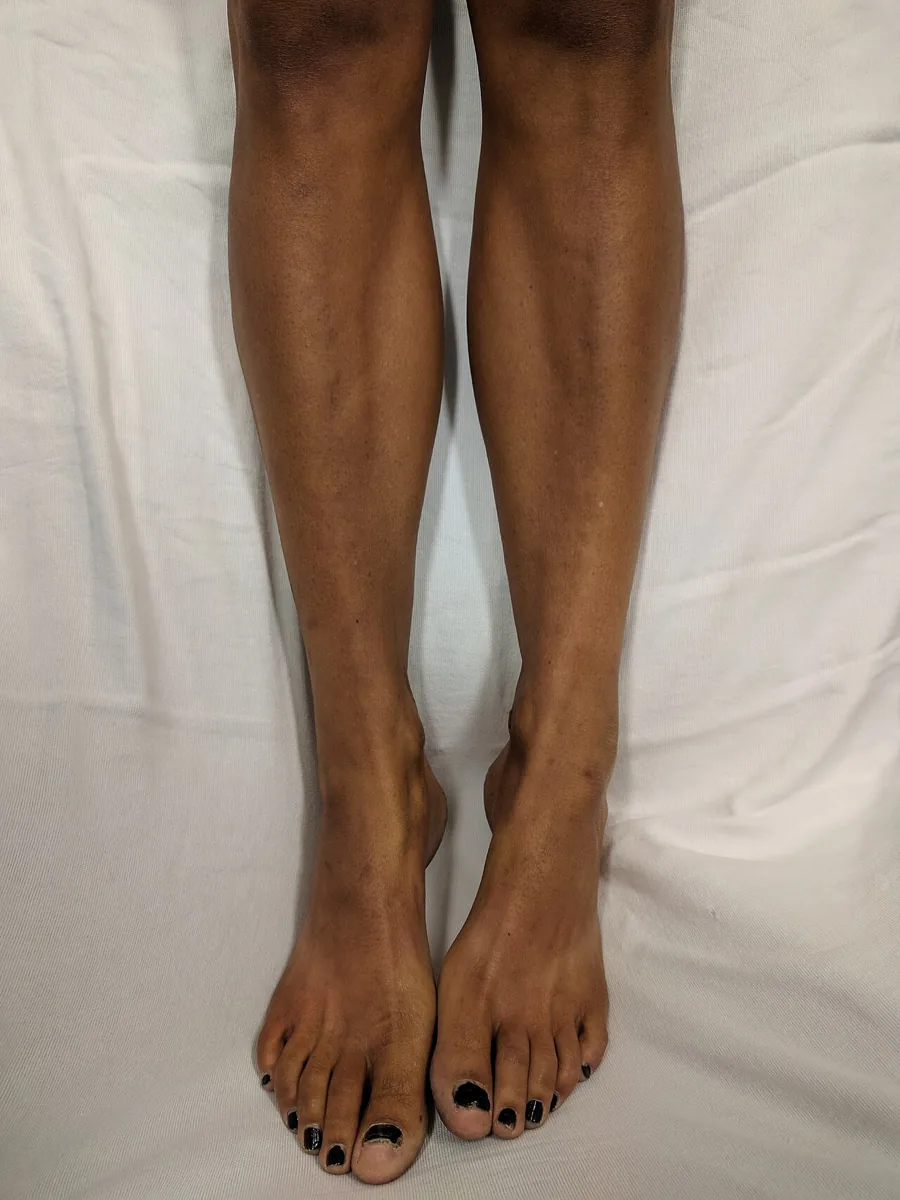 Adrenal insufficiency (Addison's disease) – clinical photo: Addison's disease: diffuse brownish hyperpigmentation of the skin on the lower legs