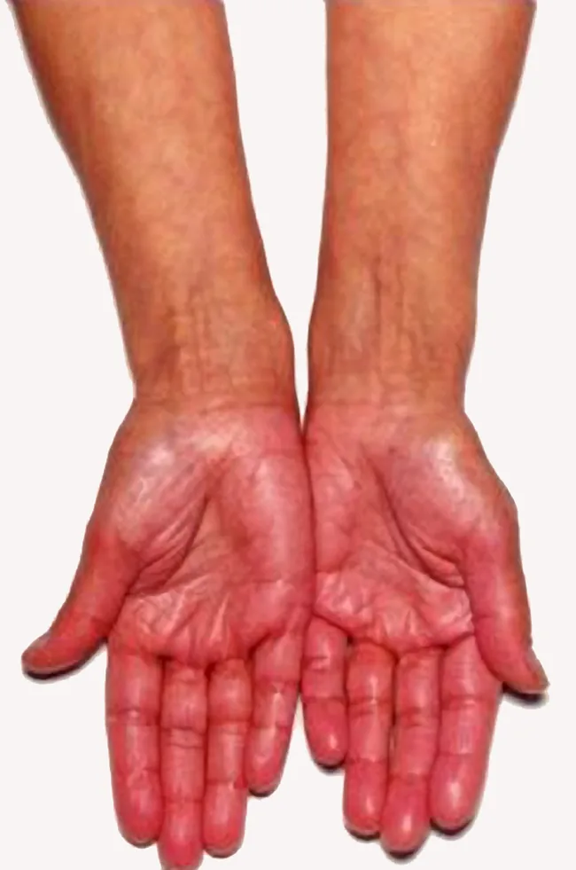 Adrenal insufficiency (Addison's disease) – hand – clinical photo: Addison's disease: hyperpigmentation of the palms with accentuated dark palmar creases