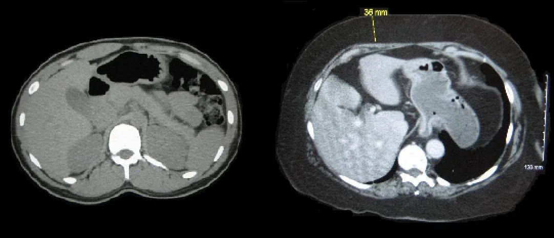 Obesity – Upper abdominal CT compared: normal-weight person on the left, obesity on the right with markedly thickened subcutaneous fat (measured 36 mm)