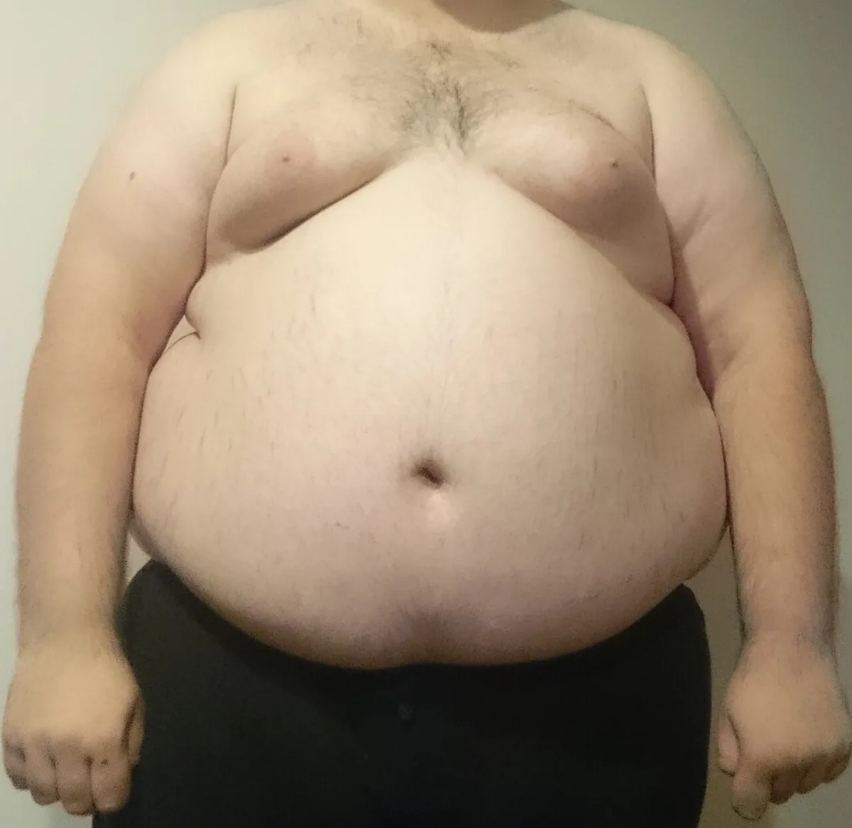 Obesity – clinical photo: Truncal (abdominal) obesity in a man: markedly protruding abdomen with a fat apron hanging over the waistband and increased fat on the chest