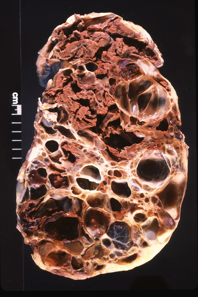 Autosomal dominant polycystic kidney disease (ADPKD) – gross specimen: Cut surface of a polycystic kidney: the parenchyma is replaced by densely packed cysts