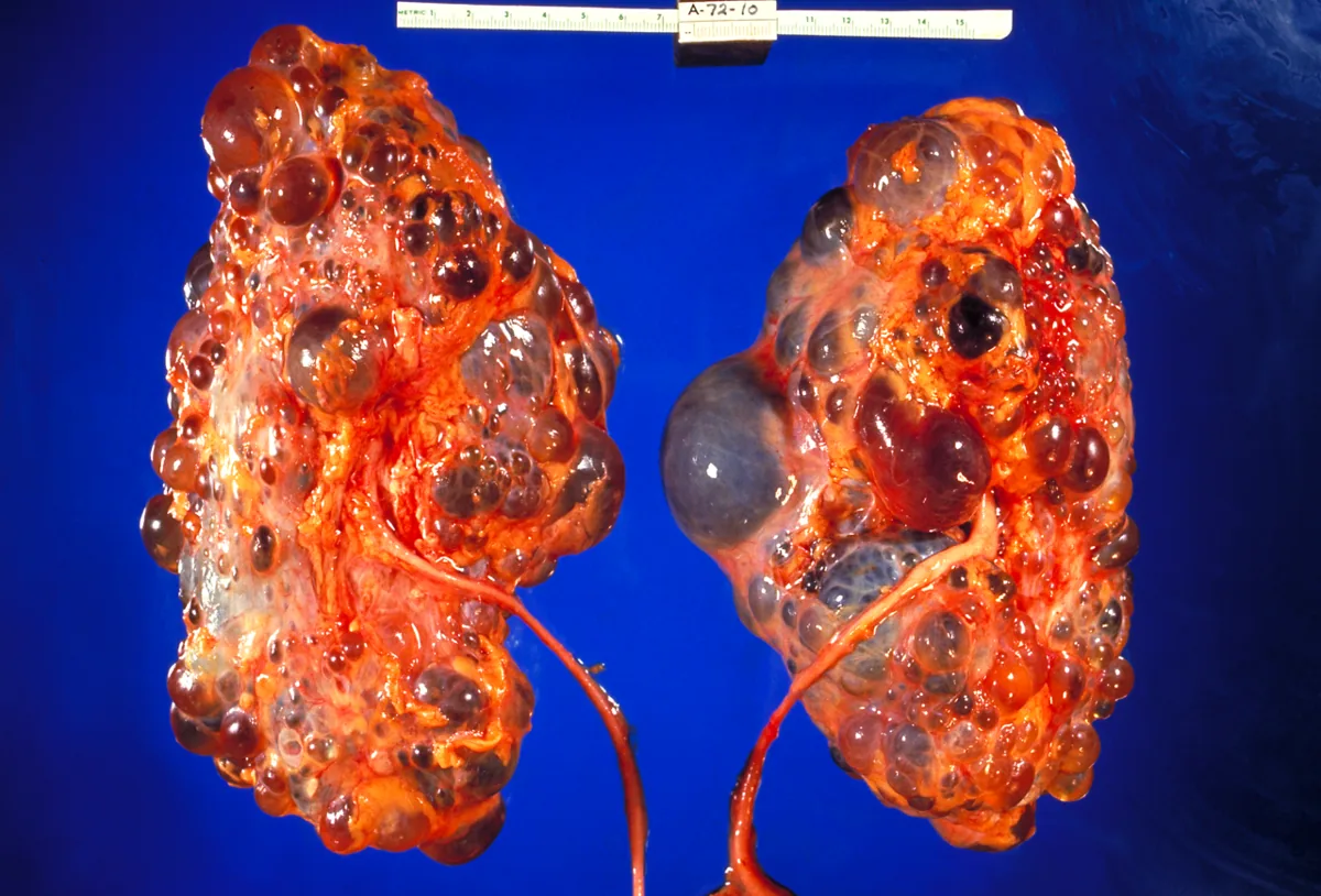 Autosomal dominant polycystic kidney disease (ADPKD) – Gross specimen of both kidneys in ADPKD: massively enlarged kidneys completely replaced by numerous cysts of varying size