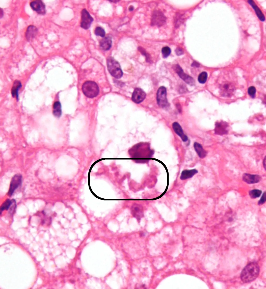 Alcoholic hepatitis – Histology (H&E, marked): Mallory-Denk body – eosinophilic, ropy inclusion in a hepatocyte in steatohepatitis