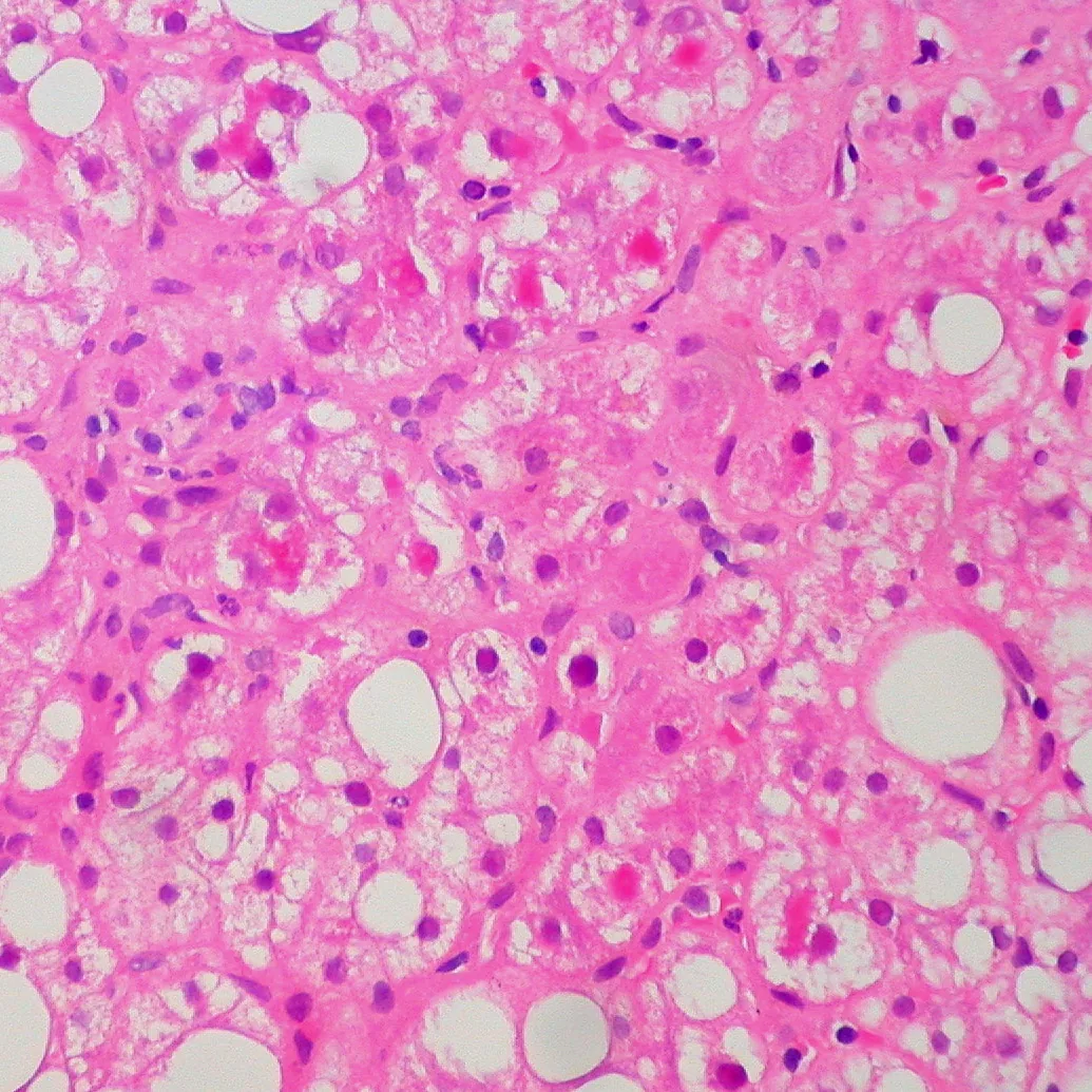 Alcoholic hepatitis – Histology (H&E) in alcohol-related liver injury: ballooned hepatocytes with eosinophilic Mallory-Denk bodies and interspersed large fat droplets
