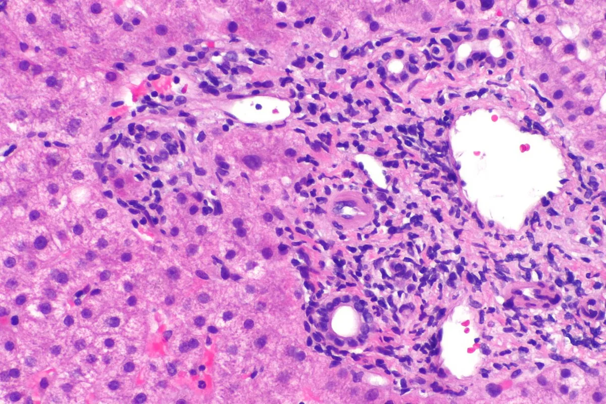 Autoimmune hepatitis – Histology (H&E), higher magnification: interface hepatitis – inflammatory cells spill over from the portal tract into adjacent hepatocytes