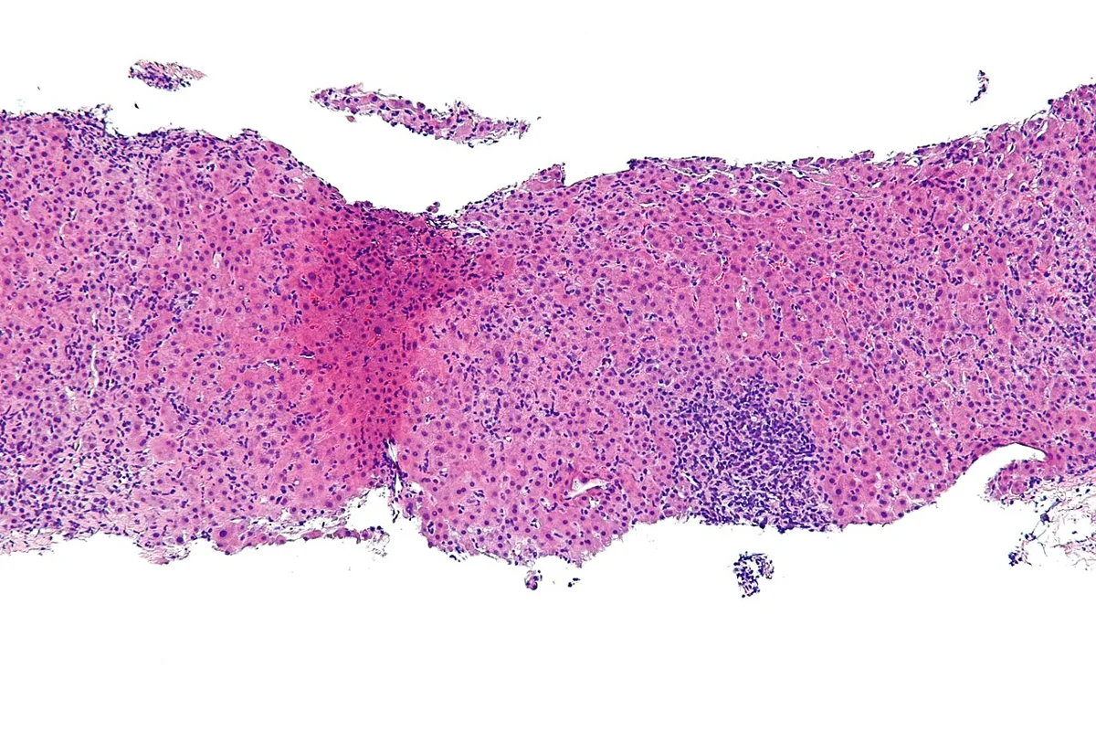 Autoimmune hepatitis – Histology (H&E): autoimmune hepatitis with lymphoplasmacytic interface hepatitis at the border between portal tract and liver parenchyma