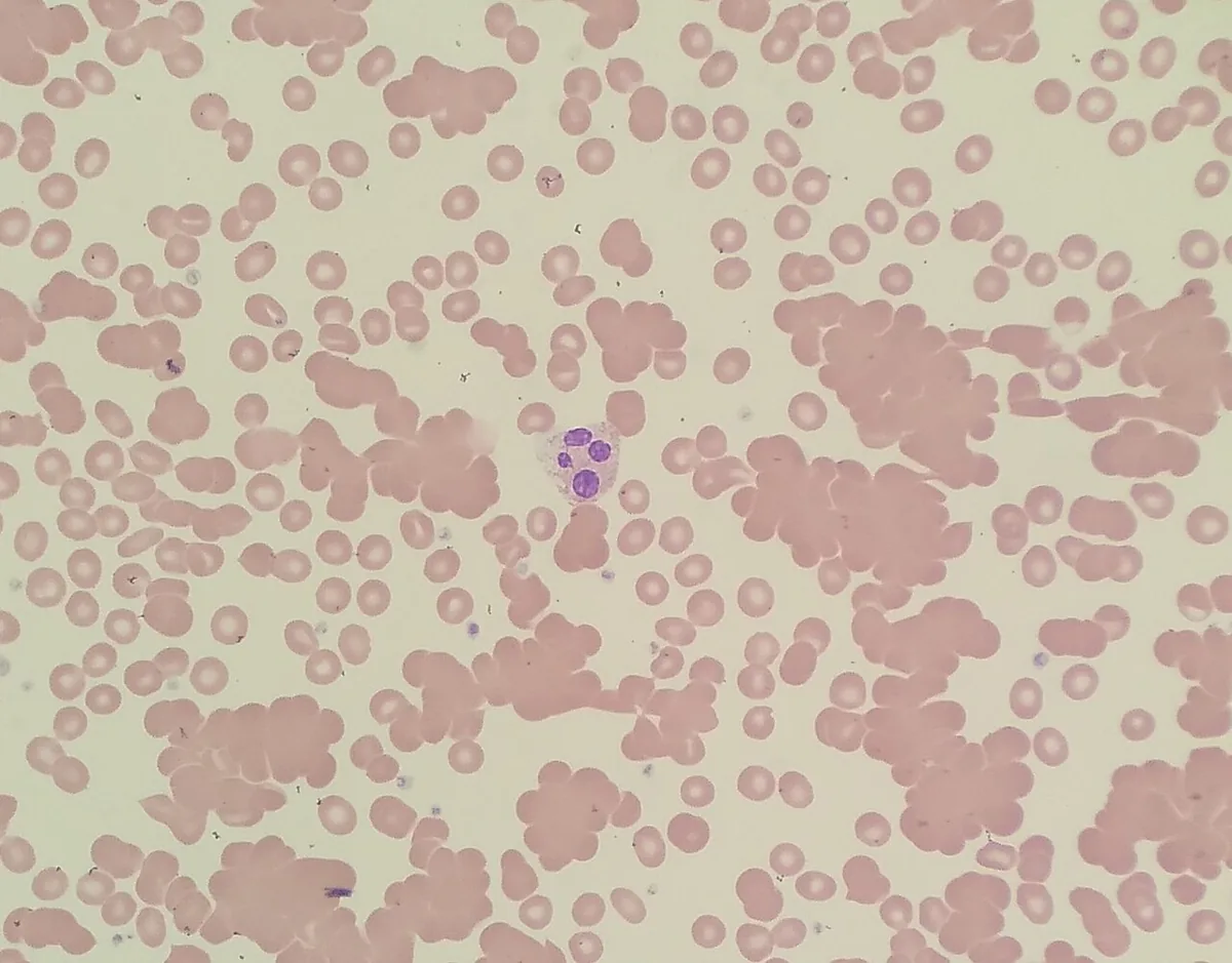 Autoimmune hemolytic anemia (AIHA) – Blood smear with cold agglutinins: red cells clumped together in large, irregular aggregates