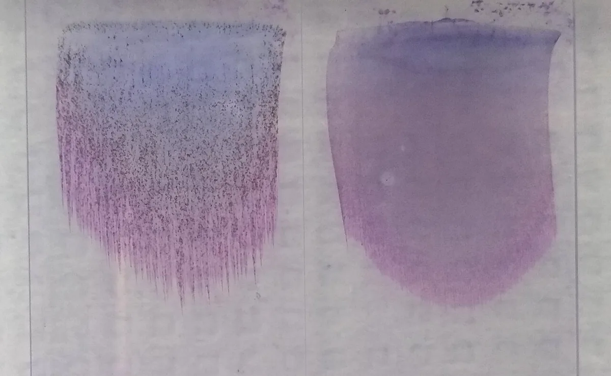 Autoimmune hemolytic anemia (AIHA) – blood smear/cytology: Slides in cold agglutinin disease: coarse granular red-cell agglutination (left) versus an even smear (right)