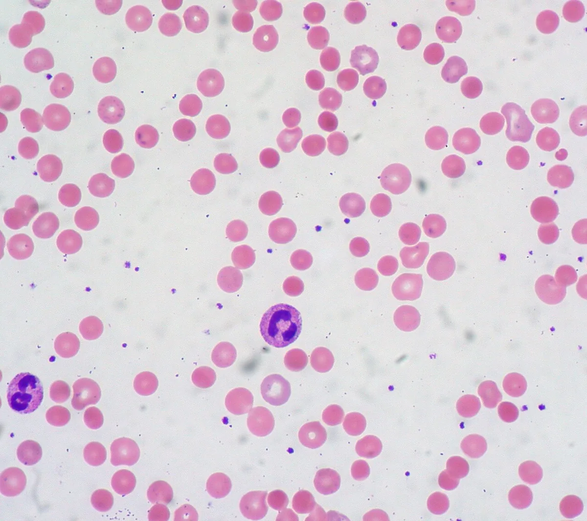 Autoimmune hemolytic anemia (AIHA) – Blood smear in warm AIHA: many spherocytes and larger, bluish polychromatic reticulocytes