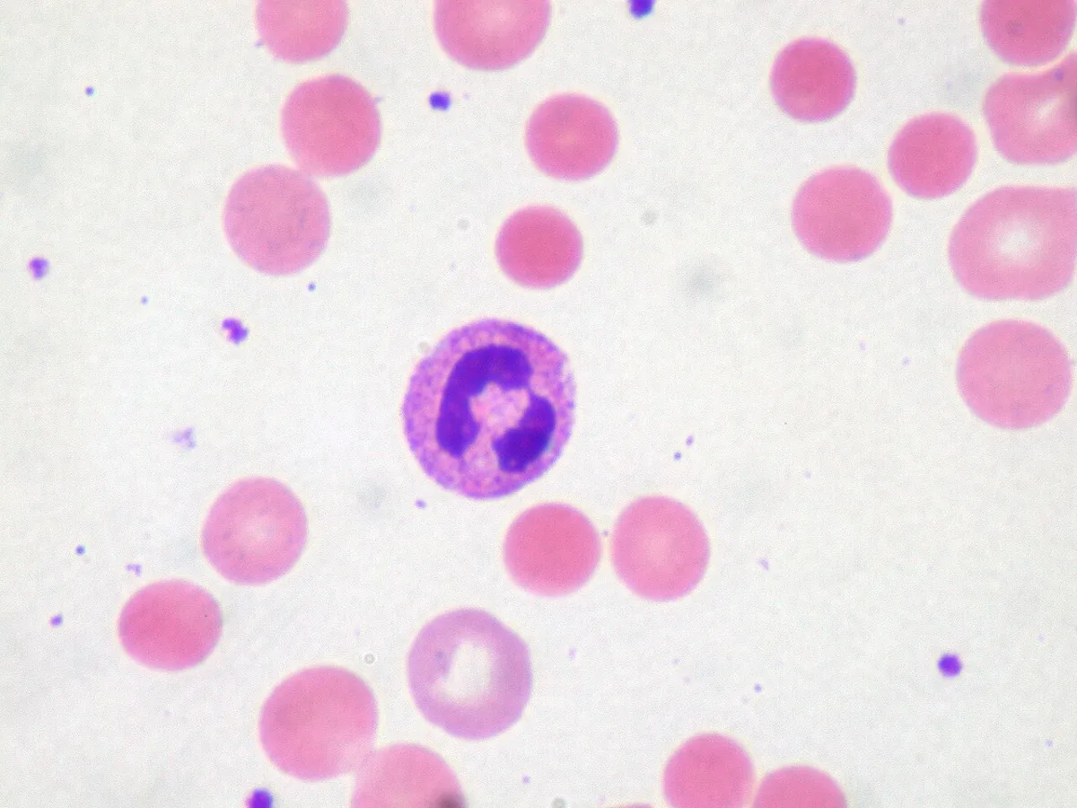 Autoimmune hemolytic anemia (AIHA) – Blood smear in warm AIHA (high power): spherocytes beside polychromatic red cells and a granulocyte