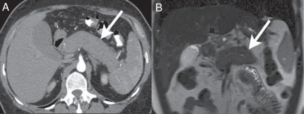 Autoimmune pancreatitis – CT (A) and MRI (B) in autoimmune pancreatitis: diffusely enlarged, sausage-shaped pancreas with reduced enhancement and no peripancreatic inflammation (arrows)