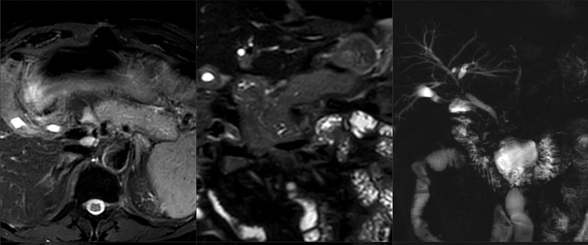 Autoimmune pancreatitis – MRI (T2, axial and coronal) and MRCP: edematous, sausage-shaped swollen pancreas with irregular ducts
