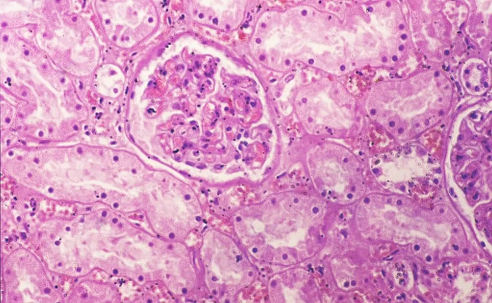 Acute kidney injury – Histology (H&E) in acute tubular necrosis: flattened, partly detached tubular epithelium and dilated tubular lumina next to a glomerulus