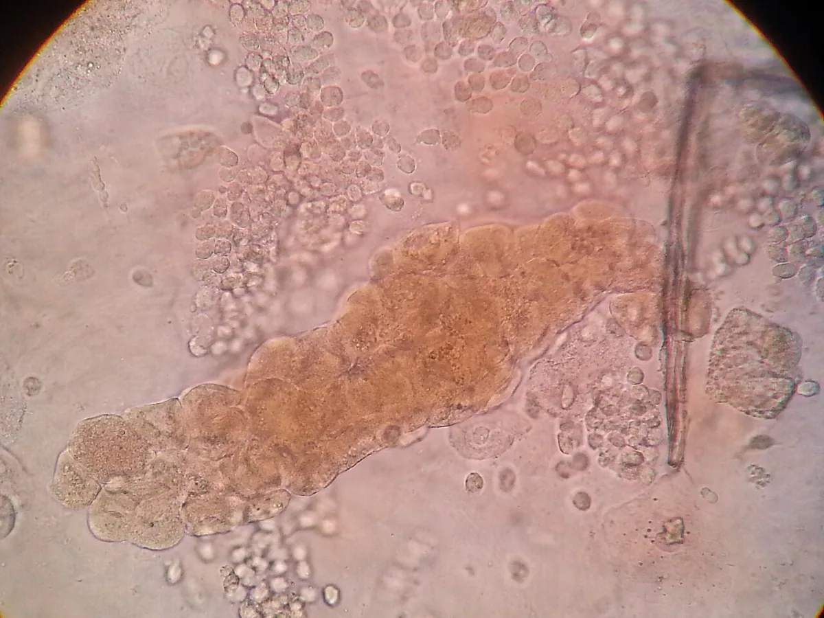 Acute kidney injury – blood smear/cytology: Urine sediment: epithelial cell cast made of shed tubular epithelial cells, surrounded by red blood cells