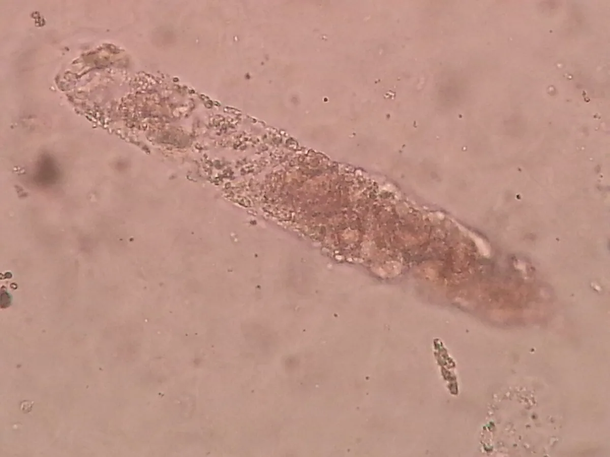 Acute kidney injury – blood smear/cytology: Urine sediment (microscopy): granular cast, an elongated mould containing tubular cell debris
