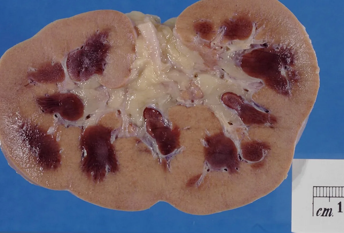 Acute kidney injury – Gross specimen of a kidney with acute cortical necrosis: pale, necrotic cortex contrasting with dark red congested medullary pyramids
