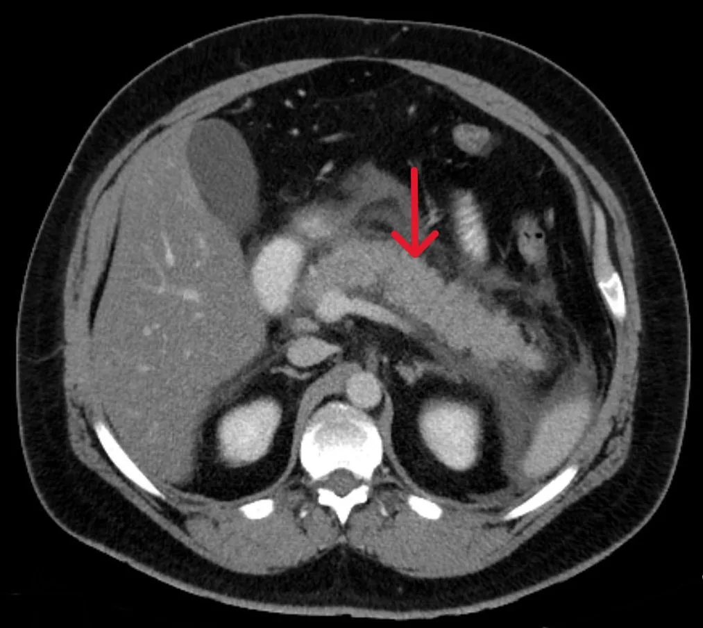 Acute pancreatitis – Contrast-enhanced CT: acute exudative pancreatitis with fluid tracking around the pancreas (arrow); parenchyma enhances normally