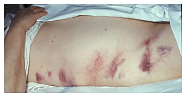 Acute pancreatitis – abdomen – clinical photo: Grey Turner sign: streaky bluish-purple ecchymoses of the flank skin in hemorrhagic pancreatitis
