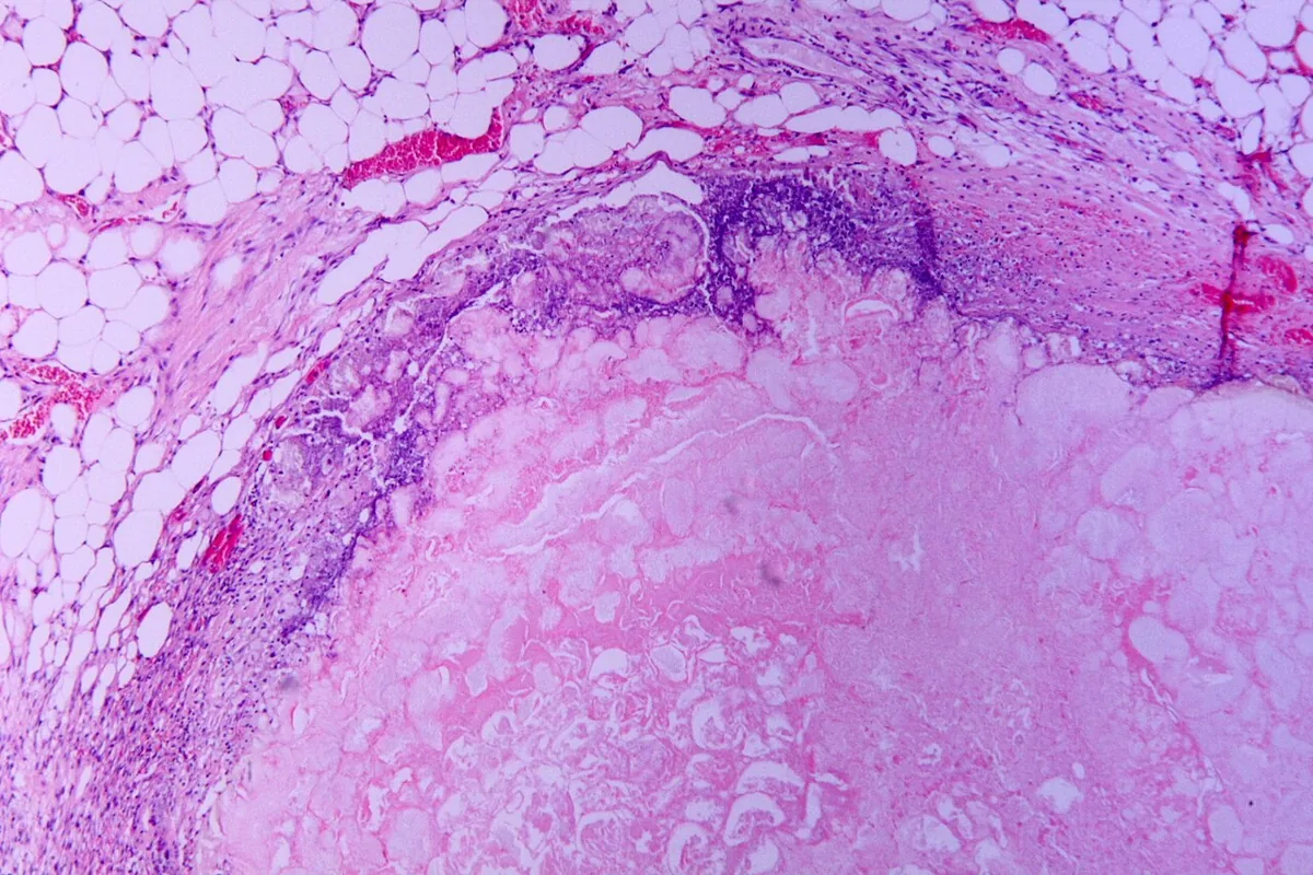 Acute pancreatitis – Histology (H&E): tryptic fat necrosis with ghost-like fat cells and an inflammatory rim