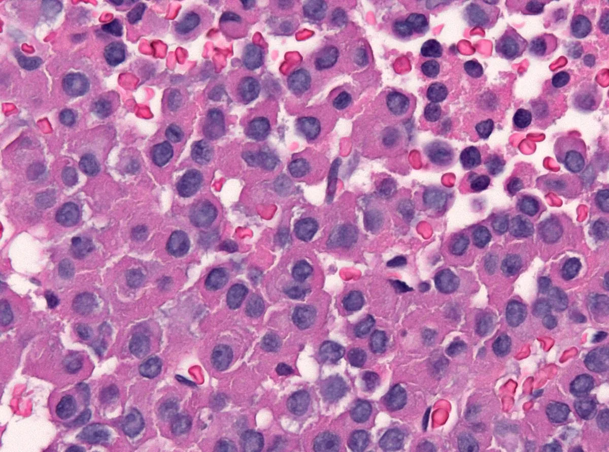 Acromegaly – Histology of a densely granulated growth-hormone-producing pituitary adenoma: solid sheets of eosinophilic tumor cells