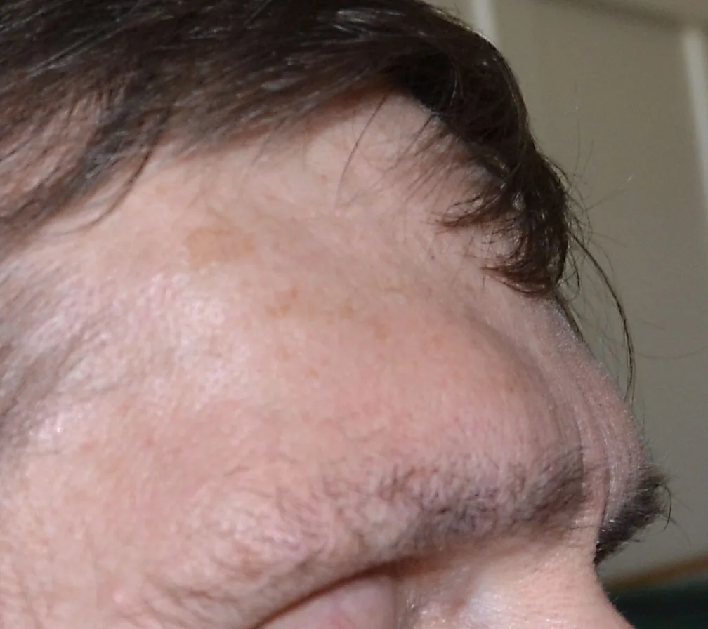 Acromegaly – face – clinical photo: Acromegaly: prominent supraorbital ridges and coarsened forehead (lateral close-up)