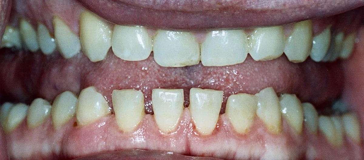 Acromegaly – clinical photo: Acromegaly: spreading teeth with gaps in the lower jaw (diastemata) due to jaw growth