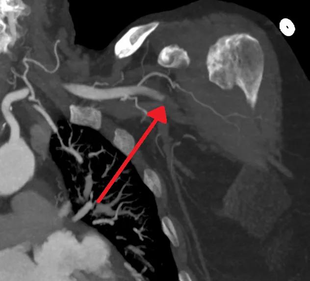 Acute limb ischemia – CT angiography (MIP): abrupt cut-off of contrast in the axillary artery (arrow) in acute occlusion with an ischemic arm