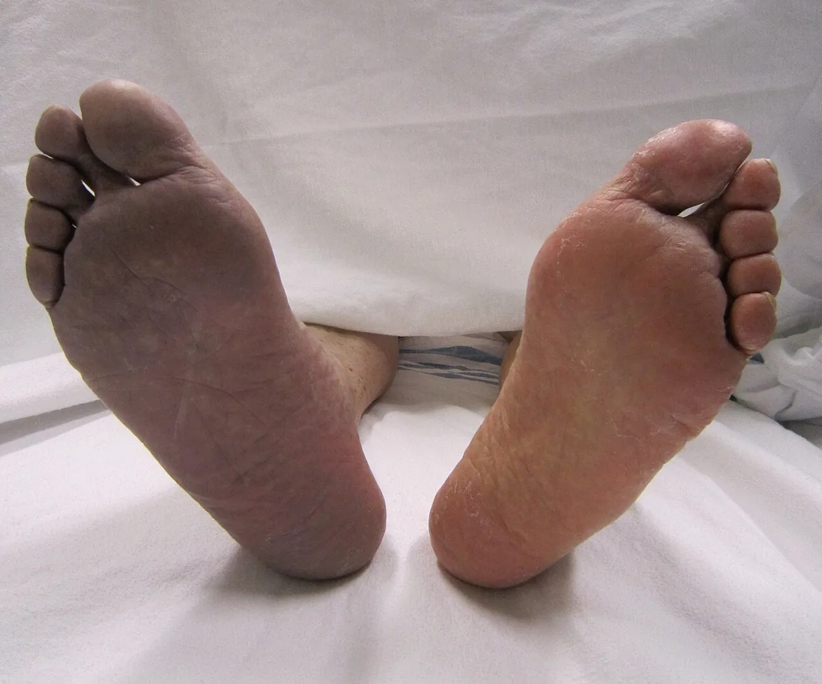 Acute limb ischemia – clinical photo: Soles compared: the right foot is livid-cyanotic distal to an acute arterial occlusion, the left foot is normally perfused